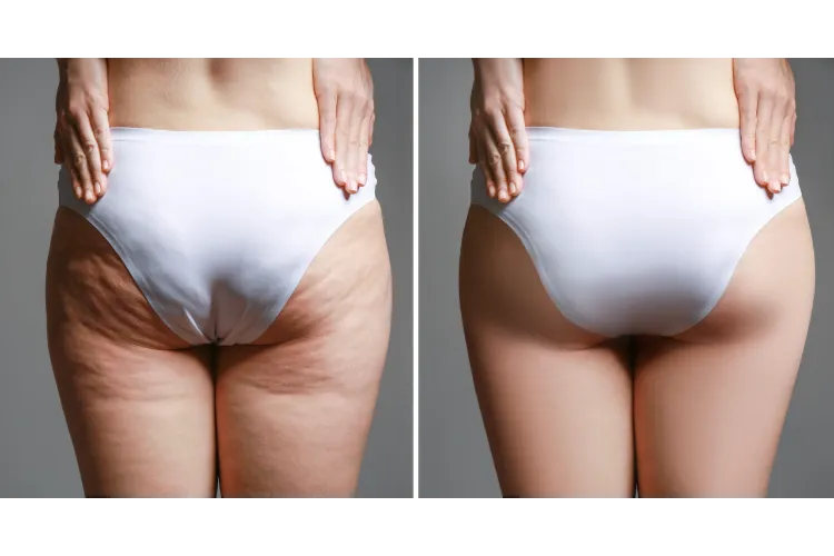What Is Cellulite