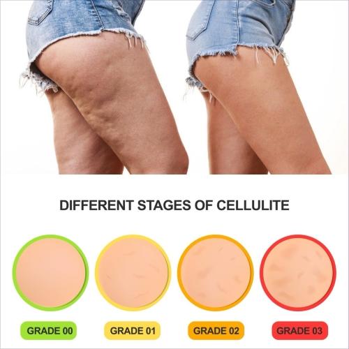 What Is Cellulite? Causes, Types & Management
