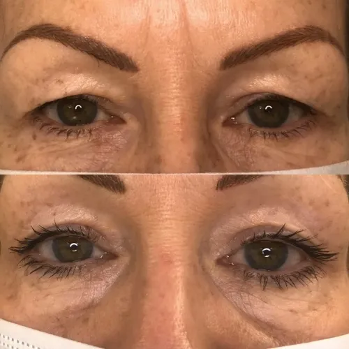 Plasm Pen vs. Morpheus8