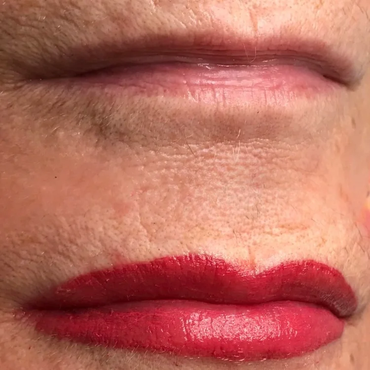 Thinning Lips Treatment