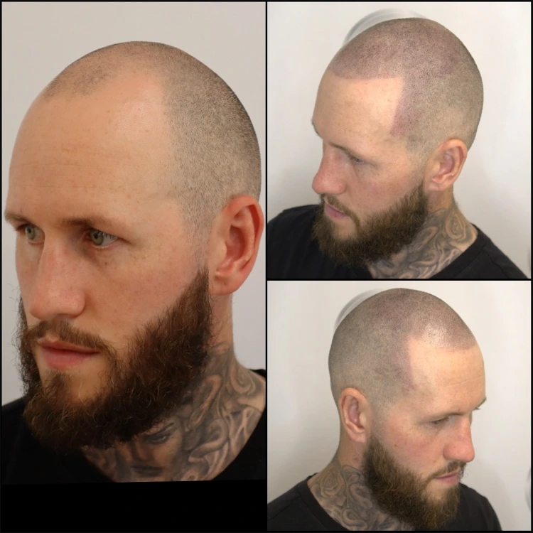 Before and after scalp micropigmentation shaved look with a more even finish