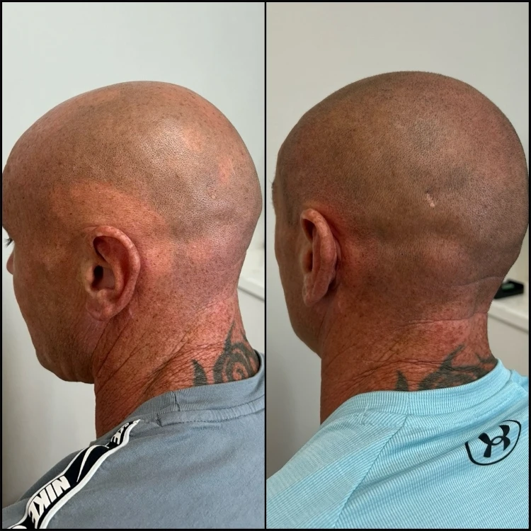 Result showing a consistent crown from above