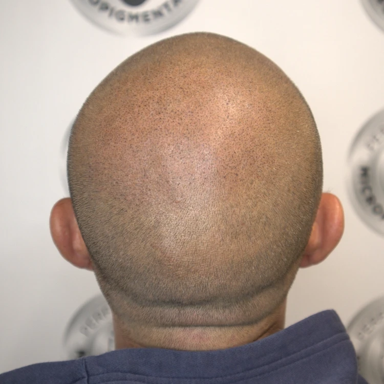 Crown SMP result blended through existing hair for a more even-looking crown