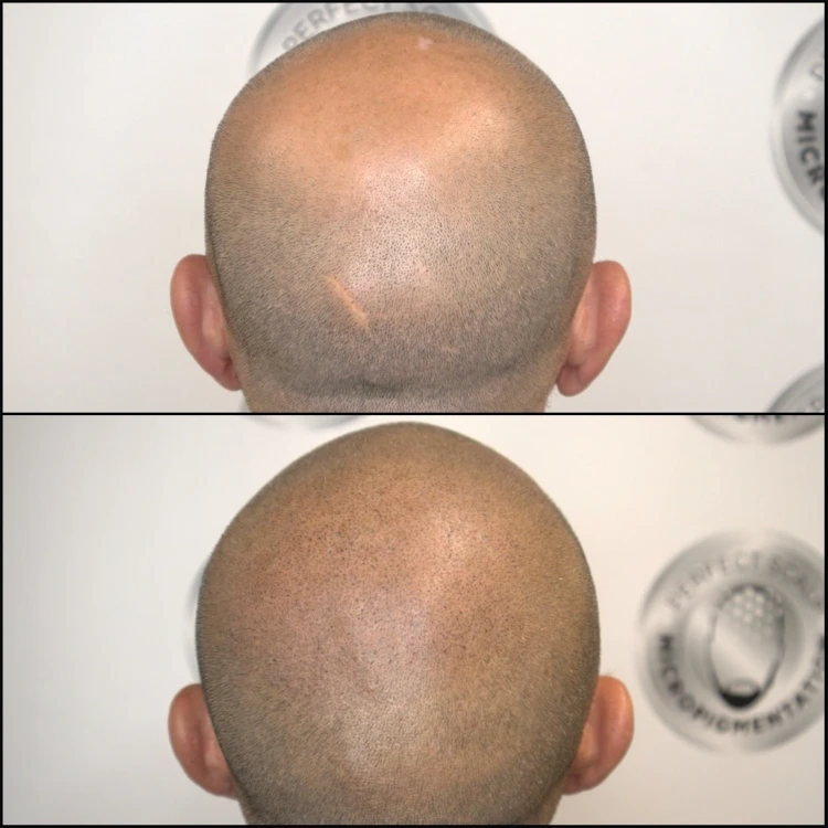 Result blended with surrounding hair for a natural-looking crown