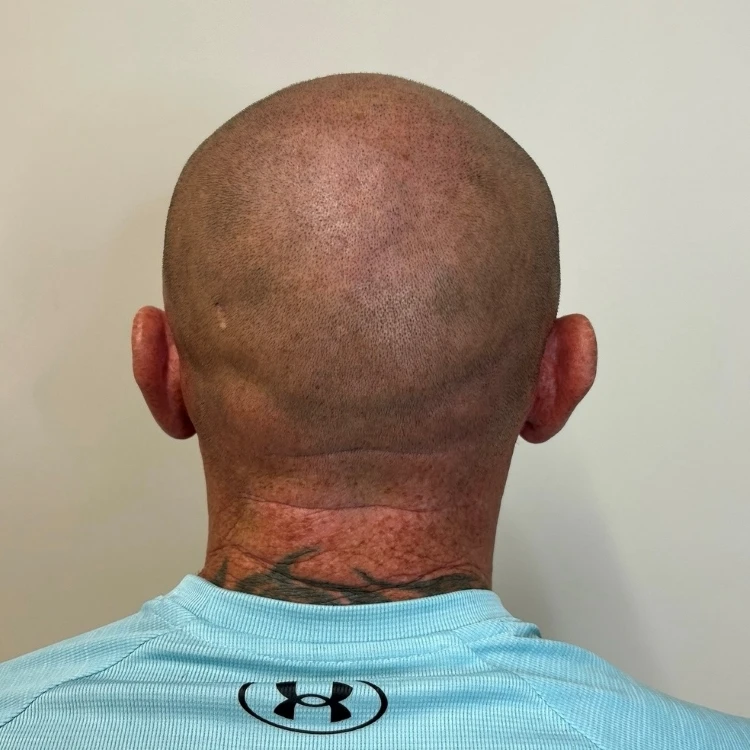 Crown SMP result on short hair showing a more consistent crown area