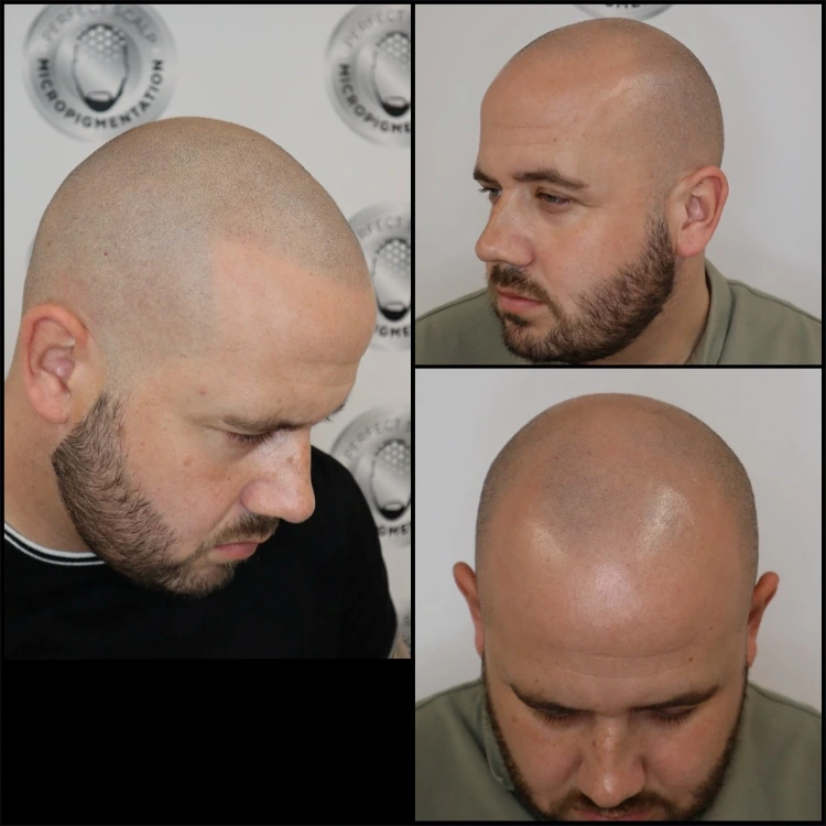Before and after hair tattoo SMP shaved look with natural follicle effect restored