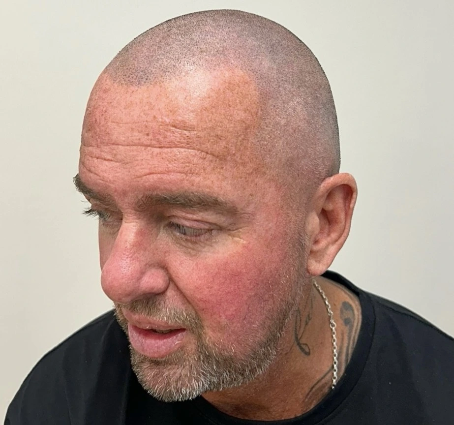 Scalp micropigmentation shaved look with subtle, realistic follicle detail