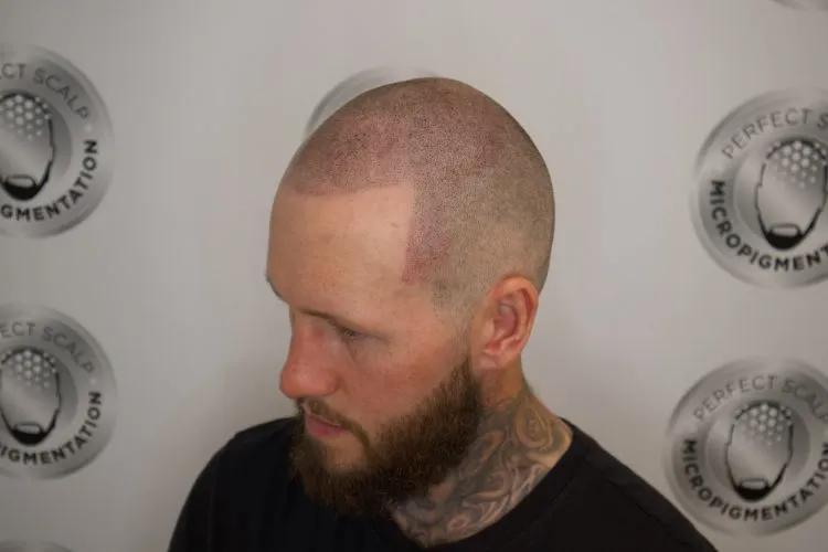 Scalp micropigmentation shaved look with a clean, consistent shaved finish