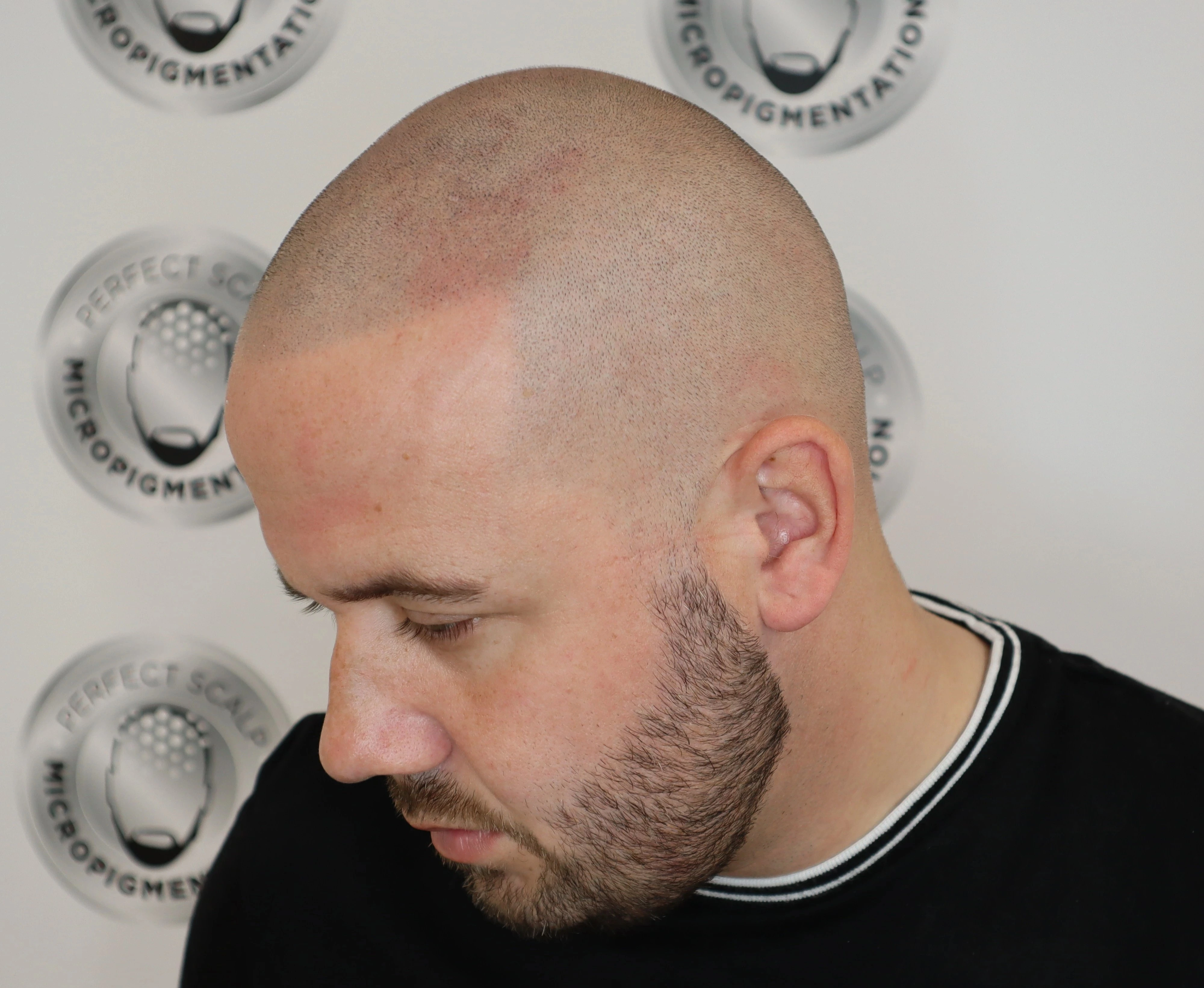 SMP shaved look result showing natural follicle effect across the scalp