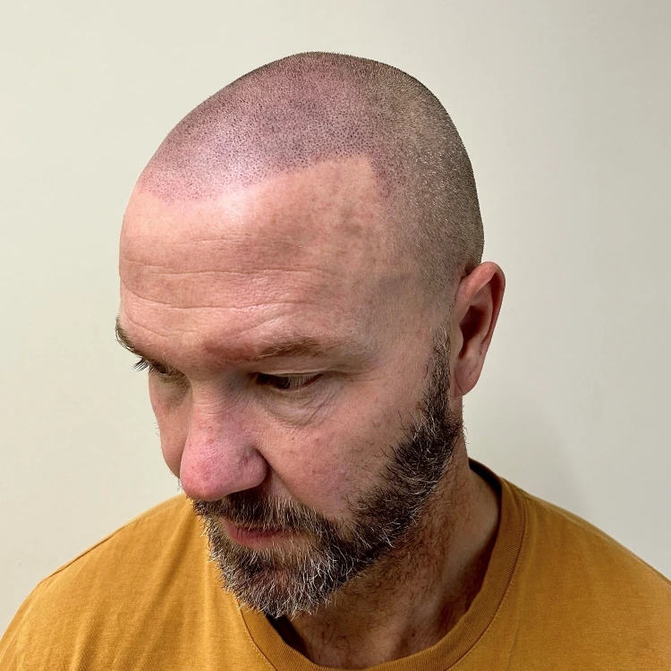 Two-year SMP shaved look photographed straight after a refresh session