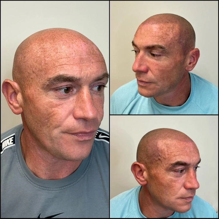 Before and after SMP shaved look demonstrating a sharper shaved appearance