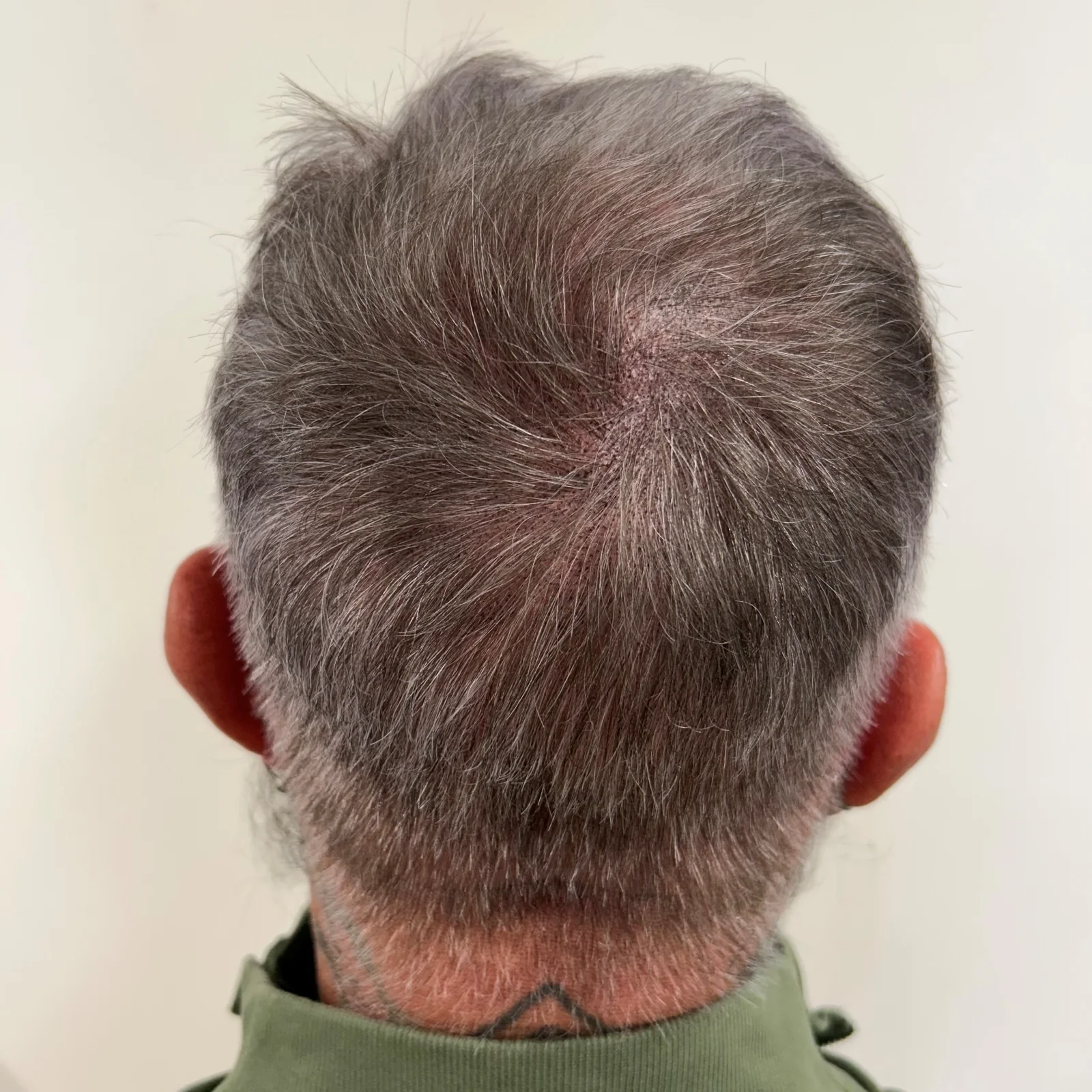 Scalp micropigmentation for crown thinning result showing reduced scalp visibility at the crown