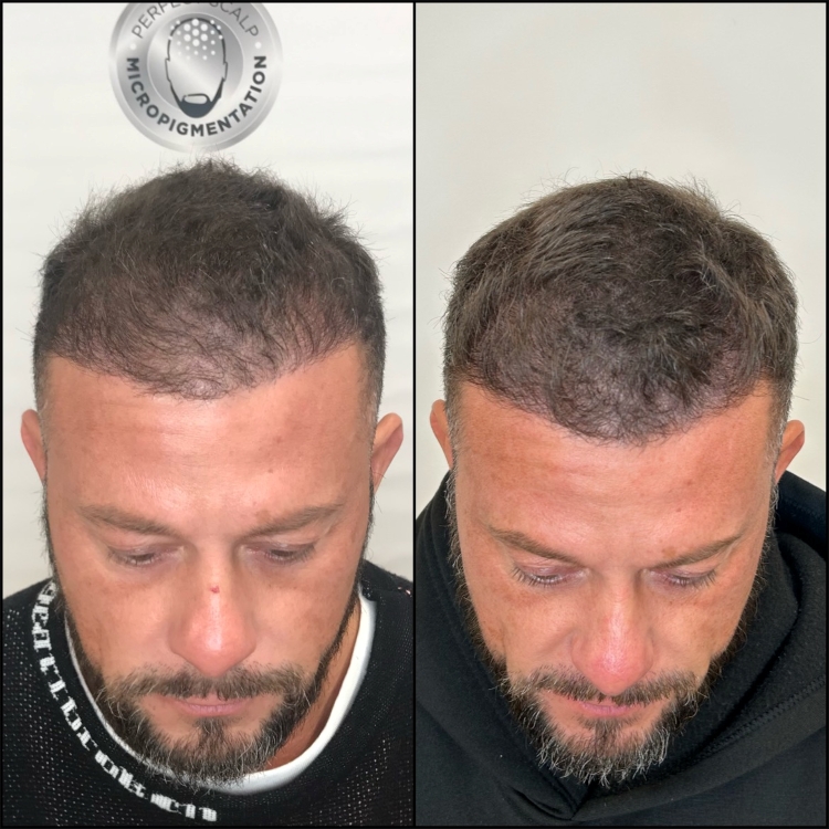 Subtle SMP density through a thinning hairline for a thicker-looking finish