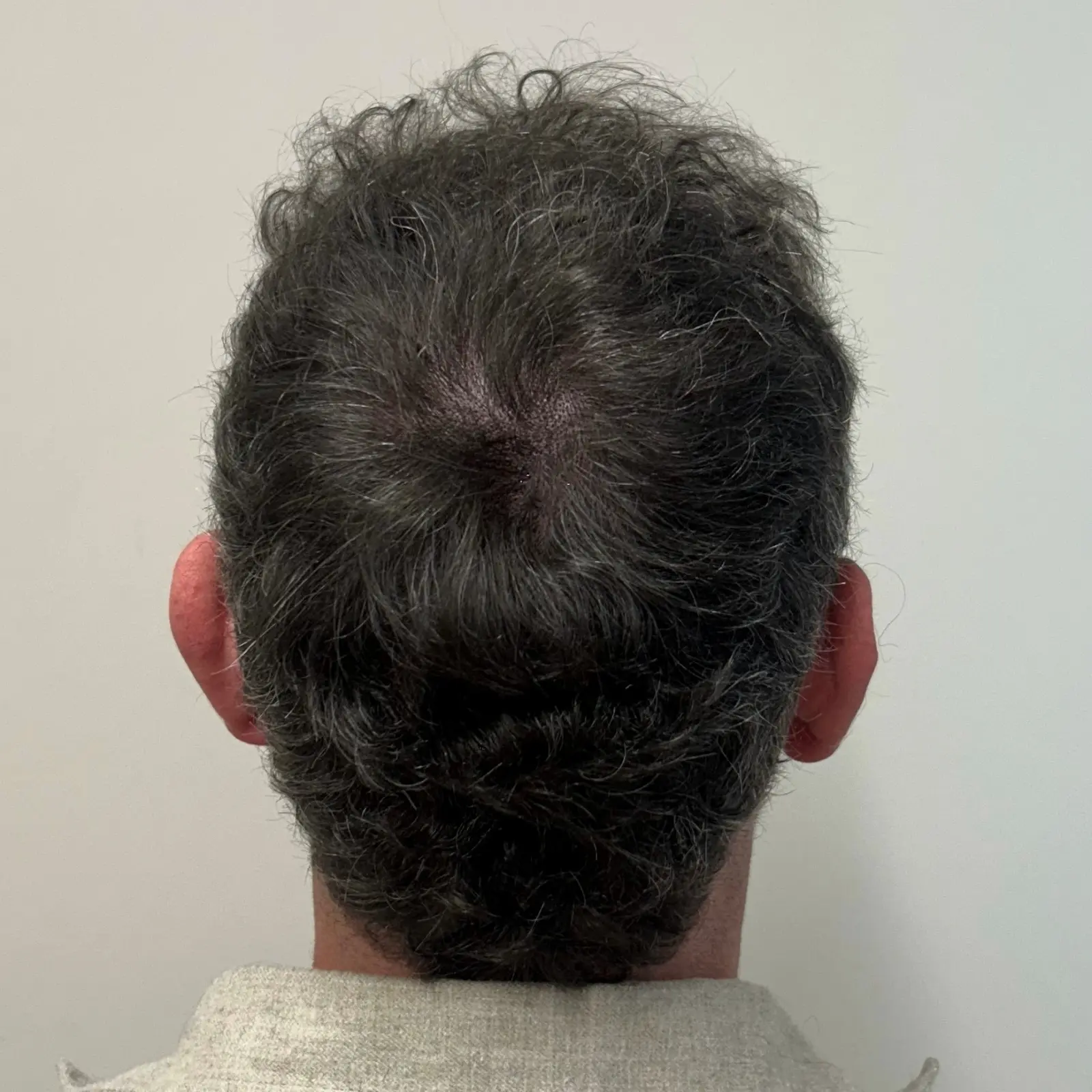 Scalp Micropigmentation density result reducing scalp show-through in thinning hair