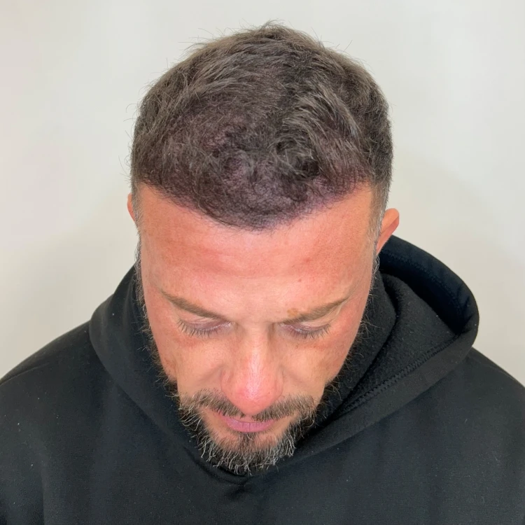 Scalp micropigmentation density result through thinning hair