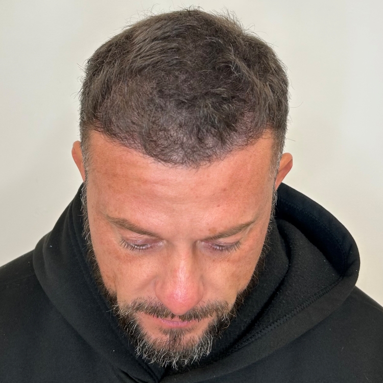 Density SMP at the hairline to reduce scalp show-through