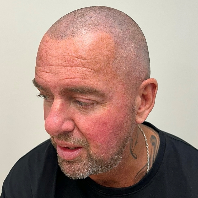Shaved-look SMP hairline restoration result