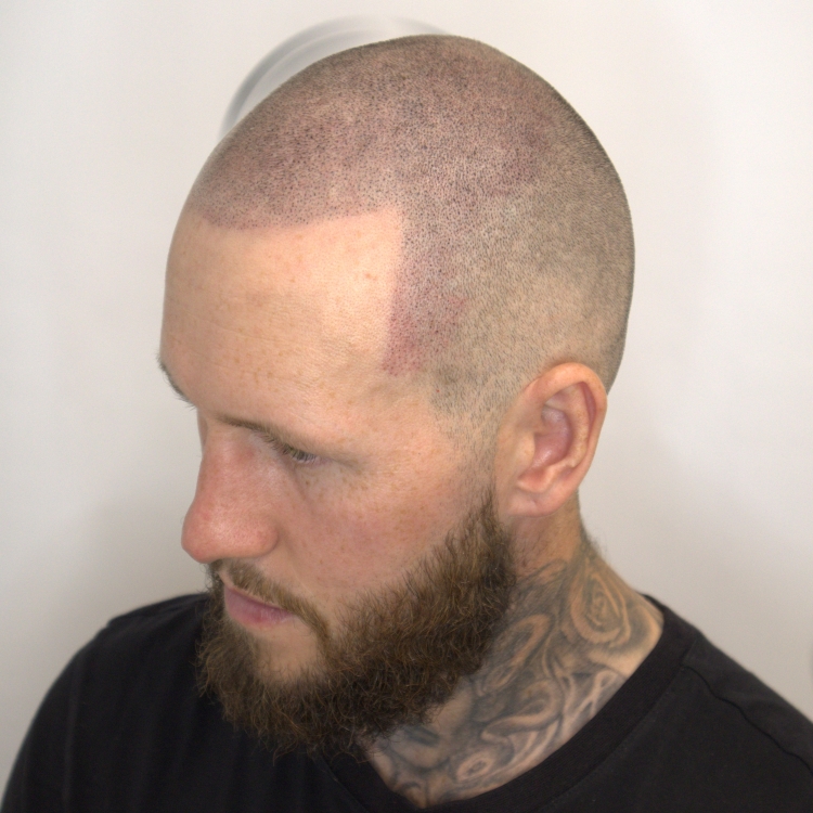 Natural-looking SMP hairline for a clean shaved-look finish