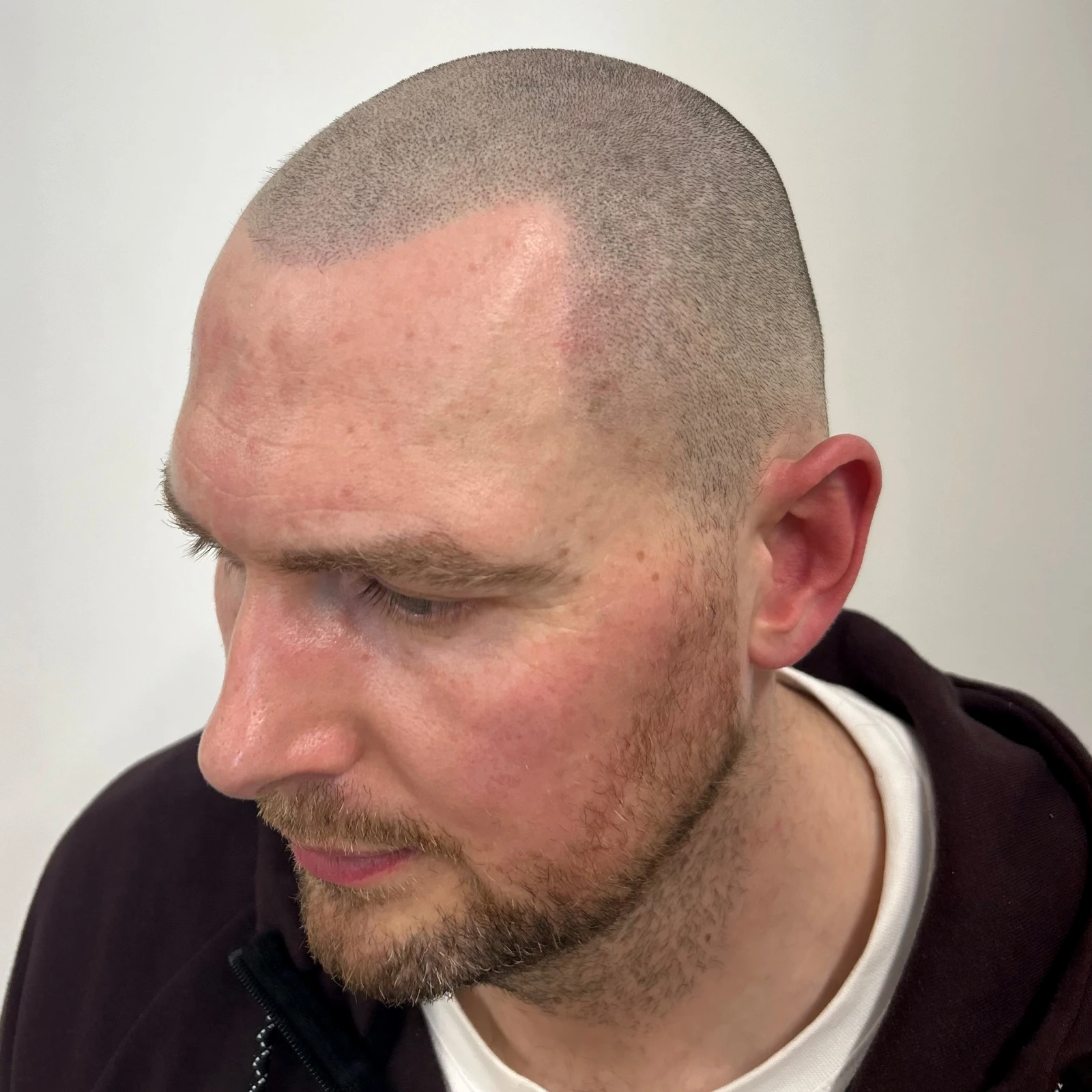 Scalp Micropigmentation hairline restoration result for a natural shaved look