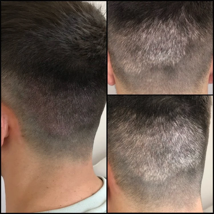 After Scalp Micropigmentation scars camouflage with a softer, more natural blend
