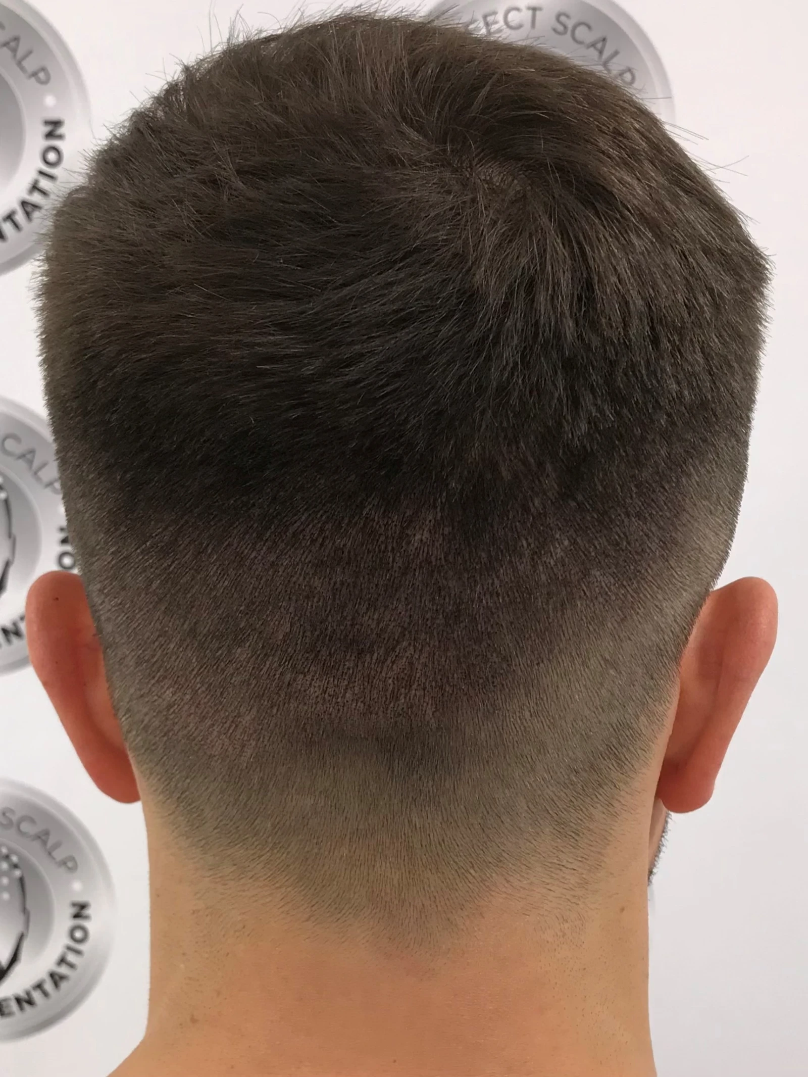 Scalp Micropigmentation scars camouflage designed to reduce scar visibility and blend naturally