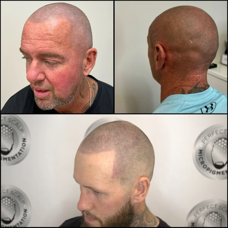 Collage showing shaved-look scalp finish and crown enhancement results