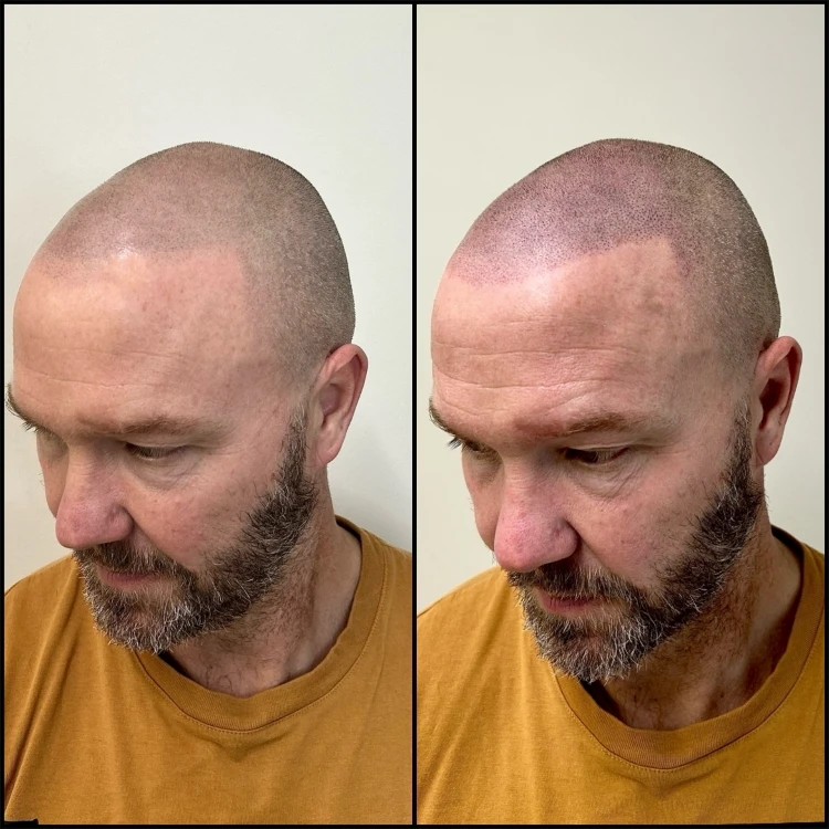 Scalp Micropigmentation Top-Up FAQ - Showing before and after side by side.