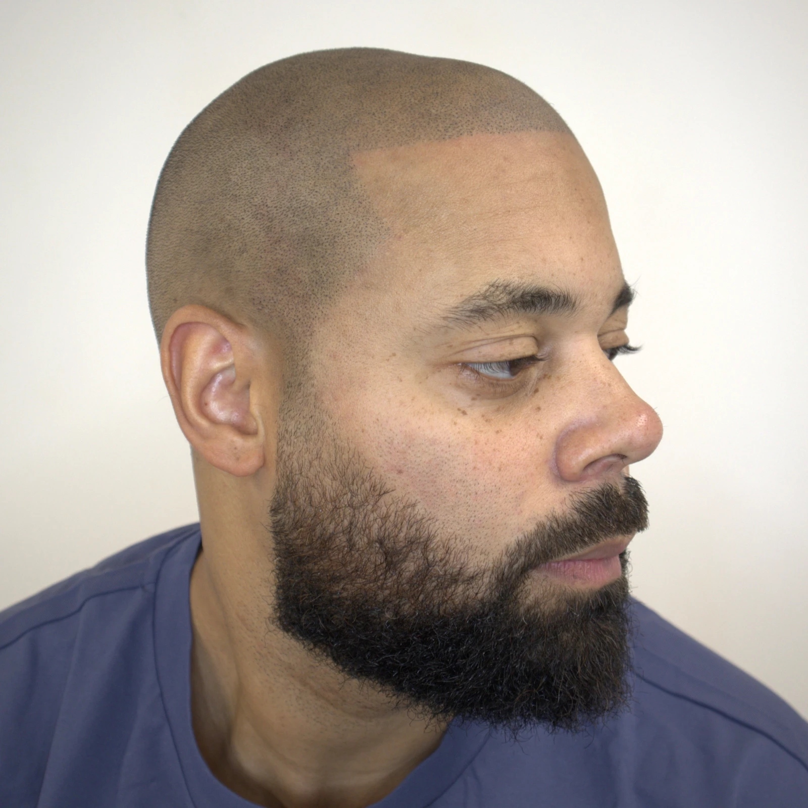 Scalp Micropigmentation Top-Up FAQ - result after treatment showing a clean, even finish in natural lighting