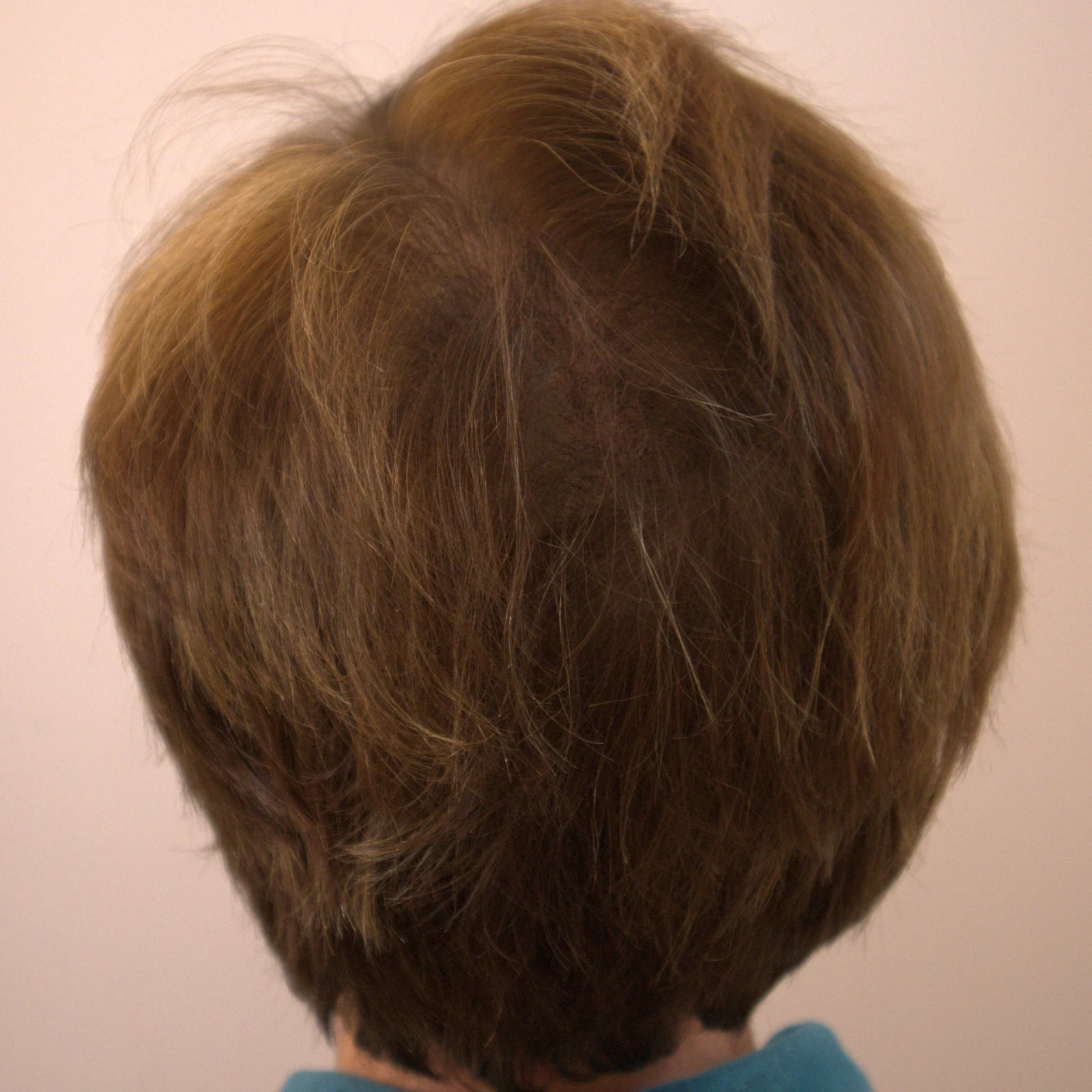 Women’s scalp micropigmentation crown density result (after)