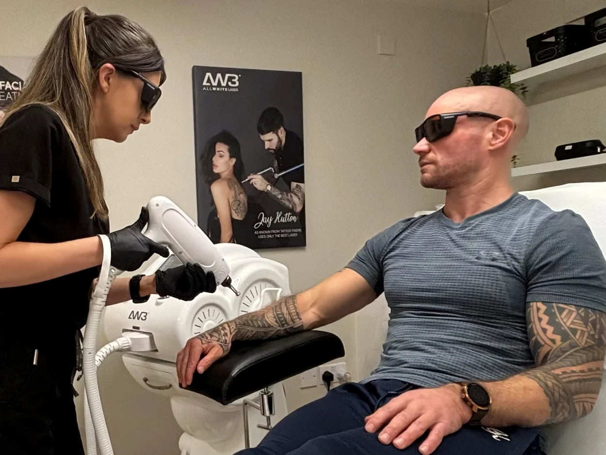 How Laser Tattoo Removal Works