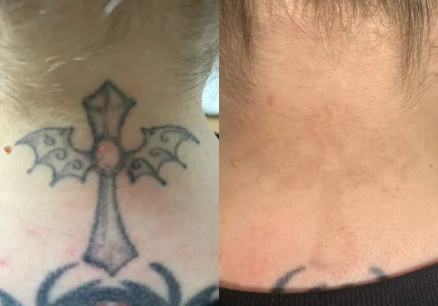 Laser Tattoo Removal Preston
