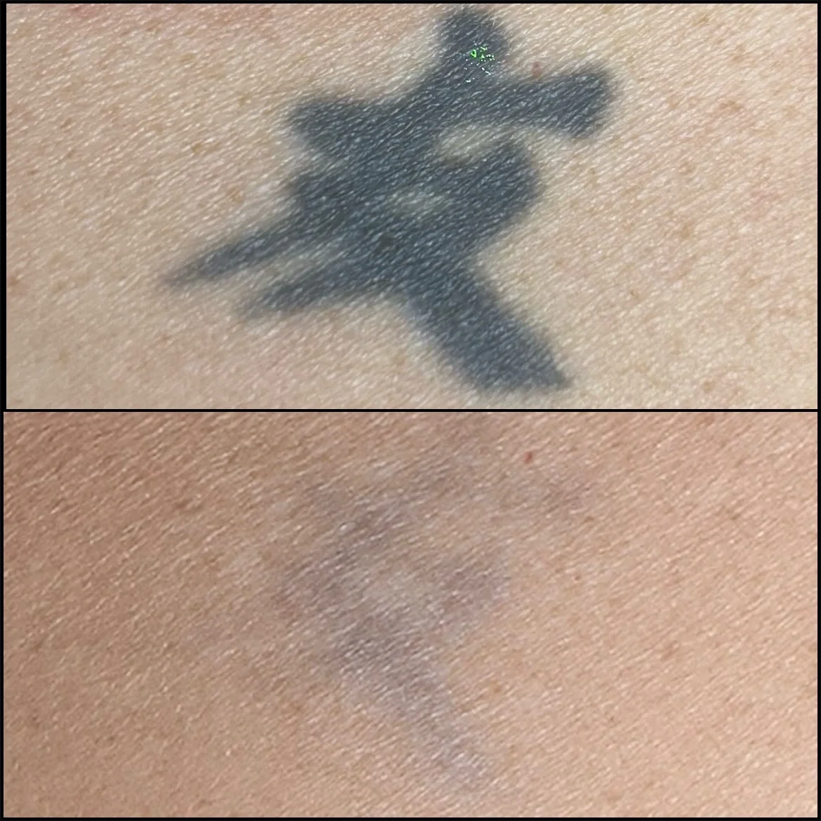 Laser Tattoo Removal Reviews Chorley