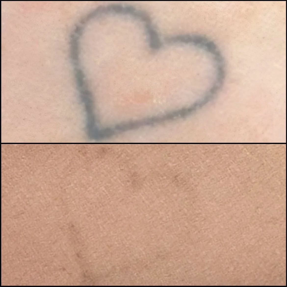 Laser tattoo removal results after 3 sessions carried out at permeant perfection near Chorley