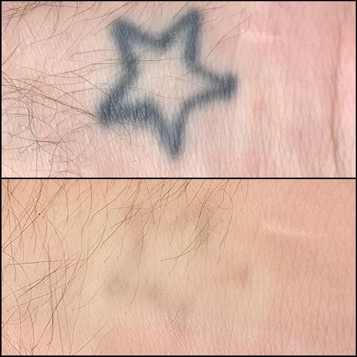 Laser Tattoo Removal results clearly showing the tattoo before laser treatment and after it conducted at permanent perfection lanca