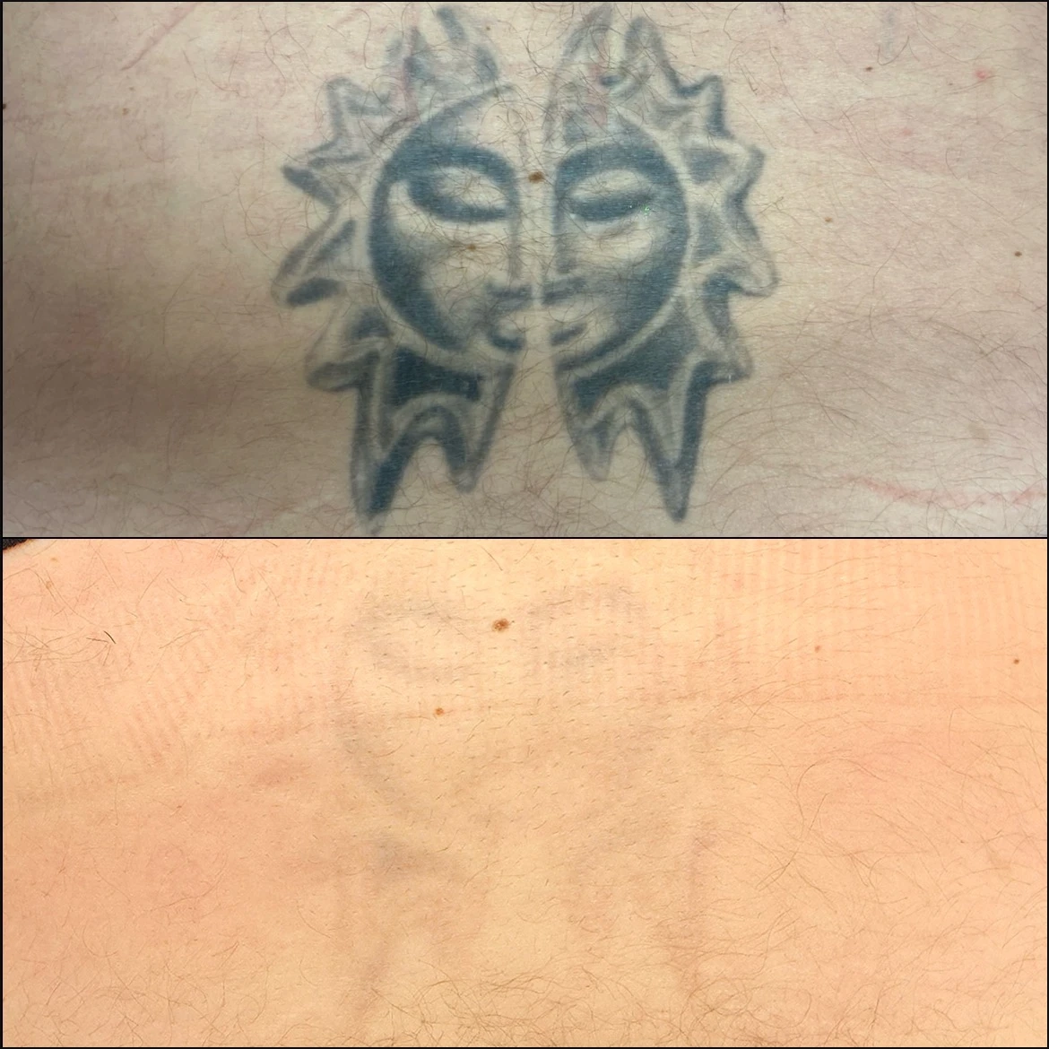 Tattoo Removal Ormskirk