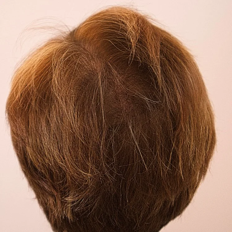 Janet’s scalp micropigmentation result for women’s thinning hair