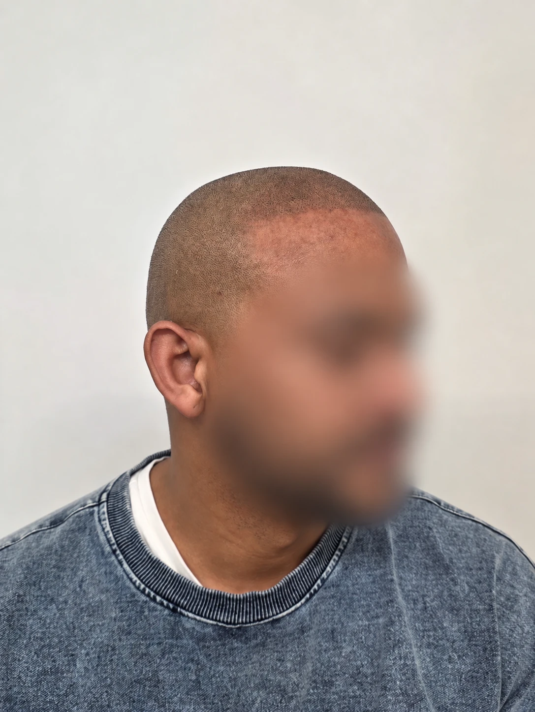 Scalp micropigmentation hairline result