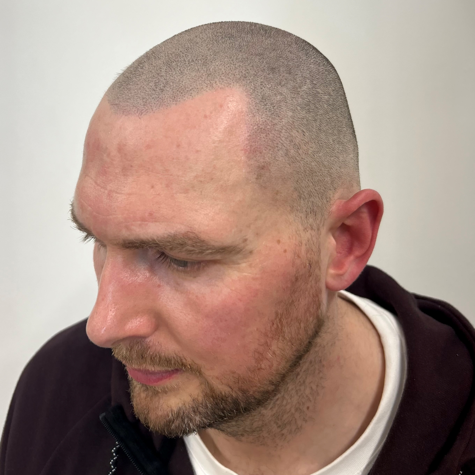 Scalp micropigmentation result created for a Wigan client