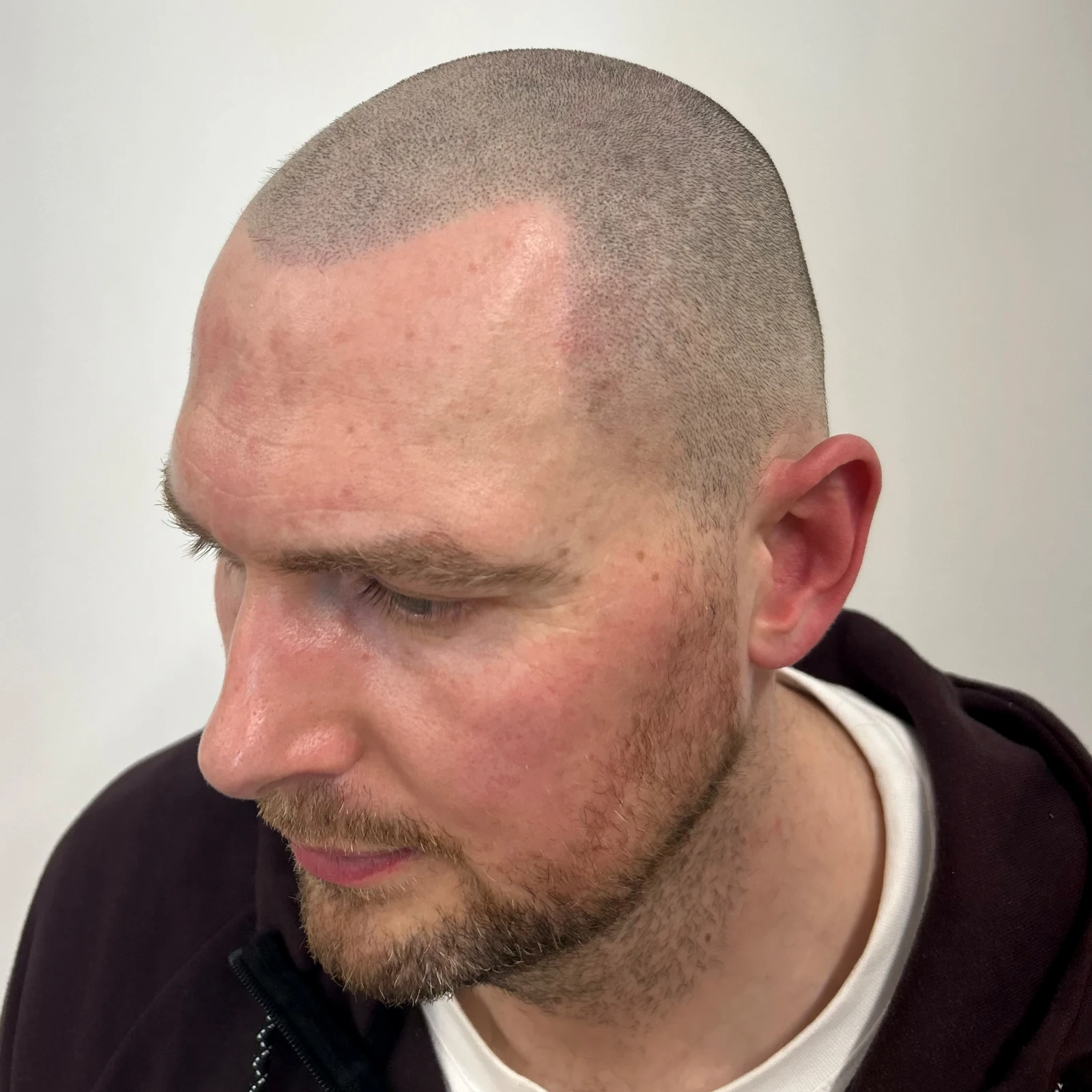 scalp micropigmentation cost Ormskirk