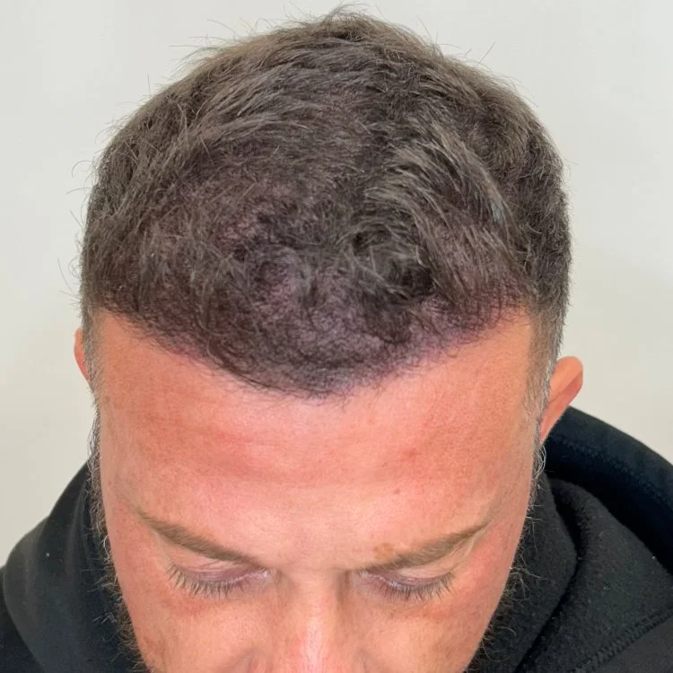 Density Hair Tattoo in Chorley