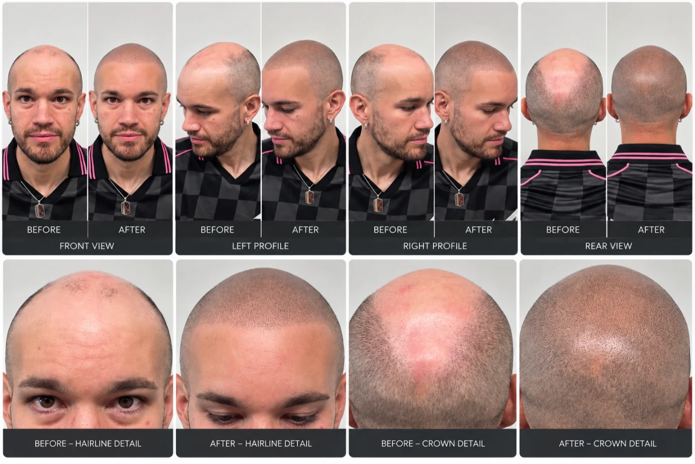 Scalp Micropigmentation