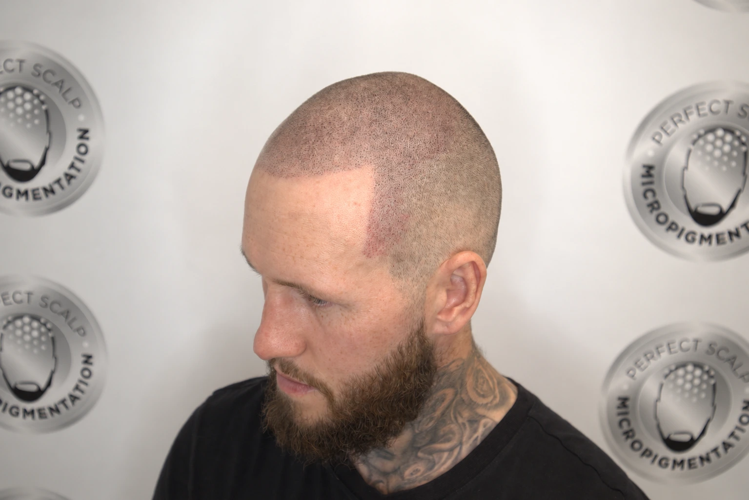 scalp micropigmentation cost Ormskirk