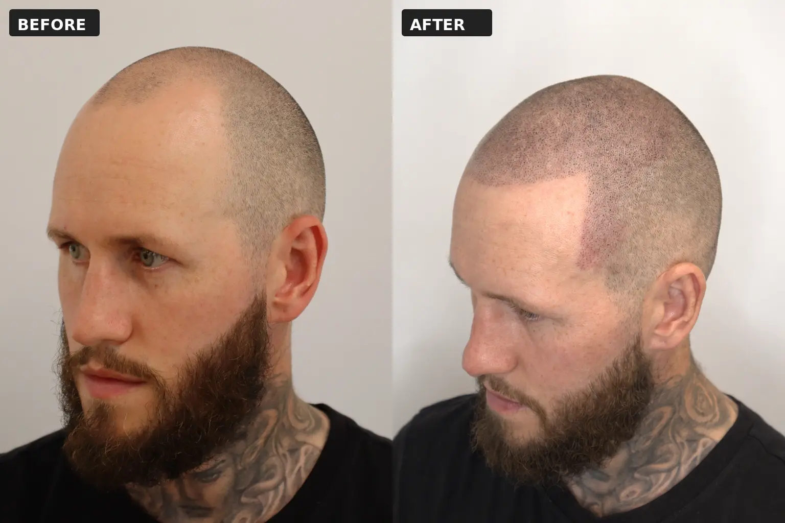 Scalp Micropigmentation for Receding Hairlines