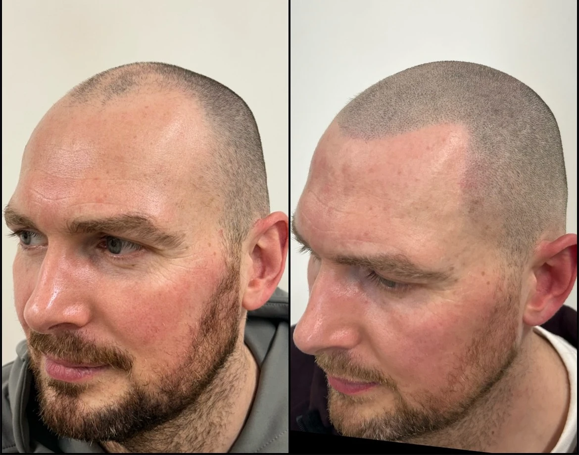 hairline Scalp Micropigmentation
