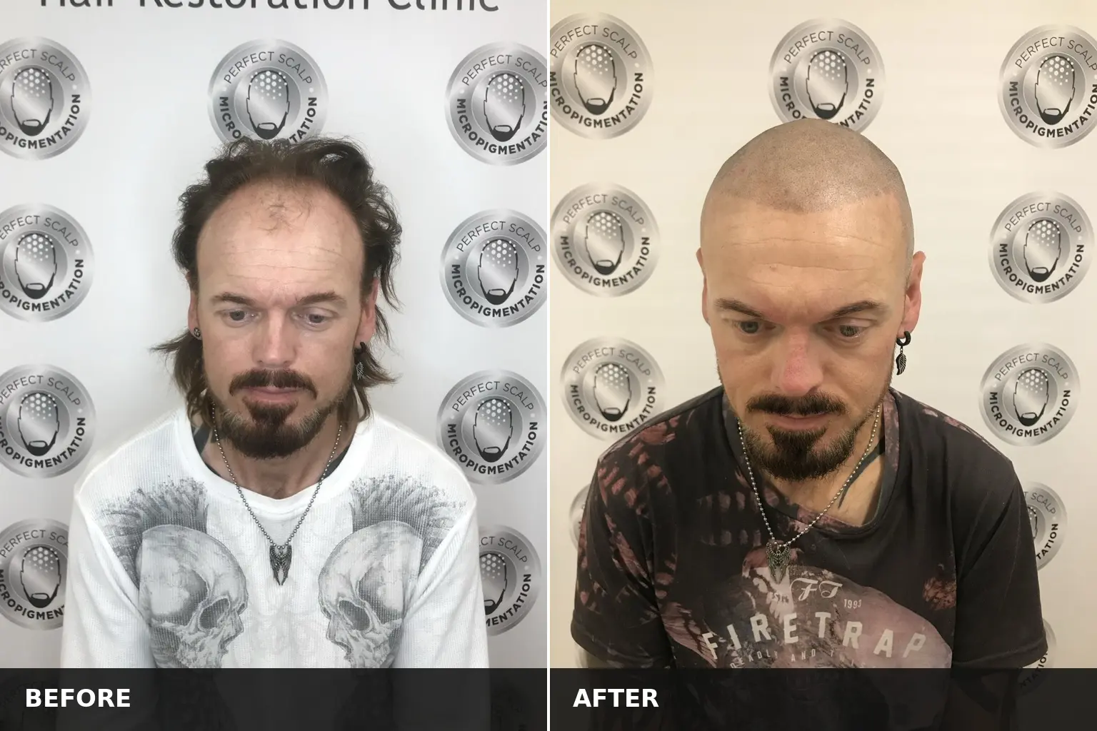 Scalp Micropigmentation Cost