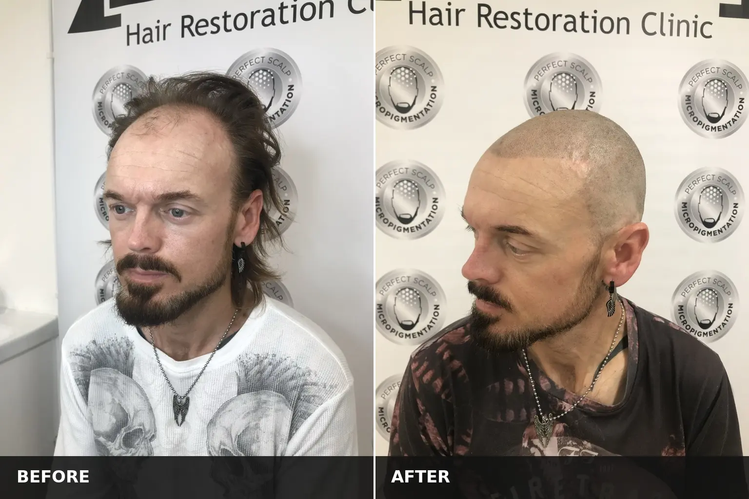 Scalp Micropigmentation Cost
