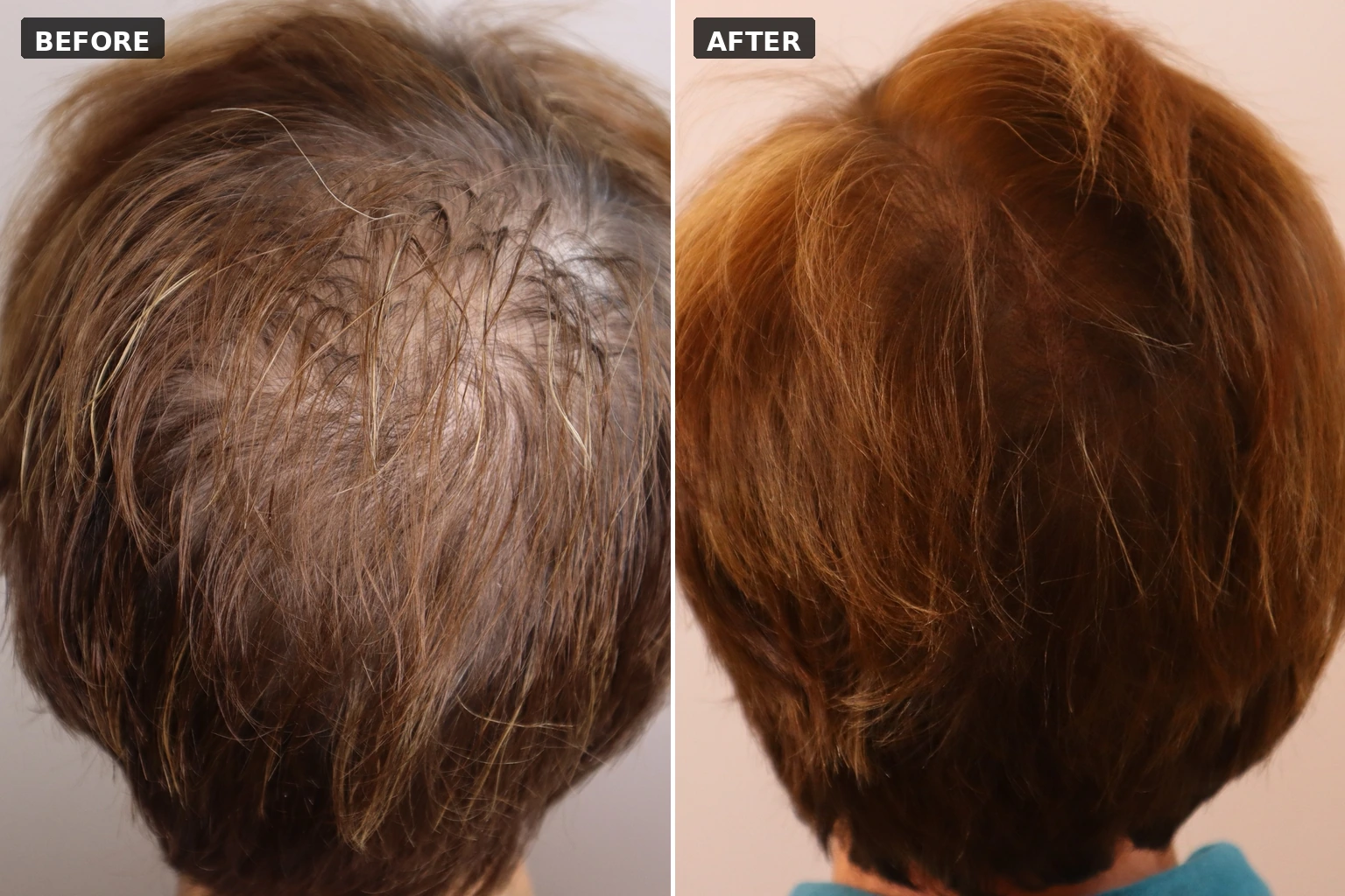 Women’s scalp micropigmentation specialist